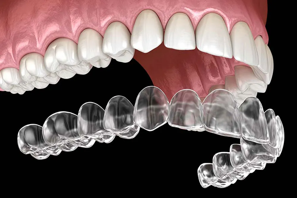 Best Dental Aligners Treatment In Bangalore | RR Nagar | Chandralayout