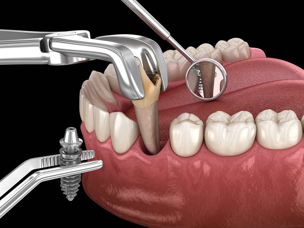 Tooth Extraction In Bangalore | RR Nagar | Chandralayout