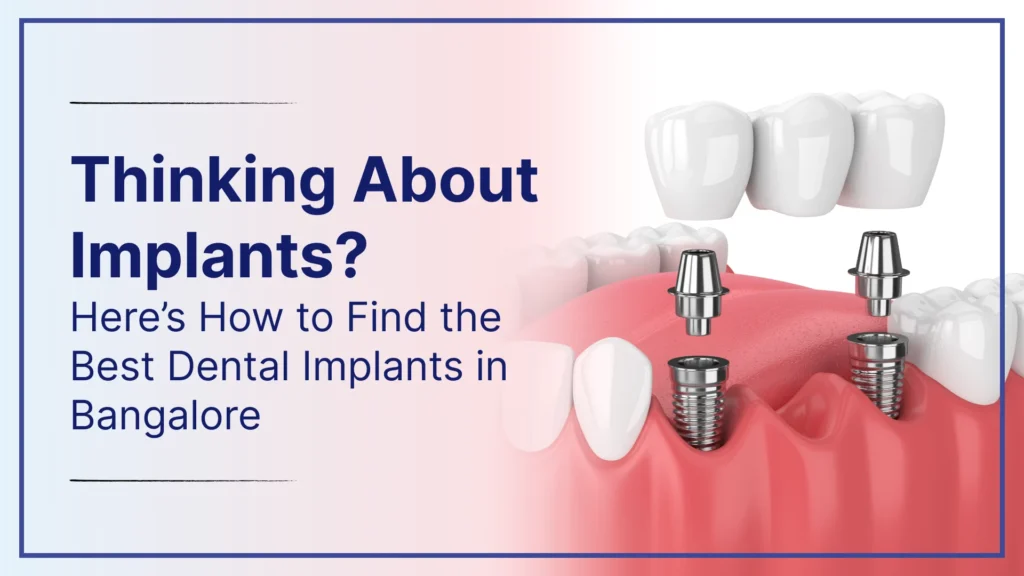 Thinking About Implants? Here’s How to Find the Best Dental Implants in Bangalore
