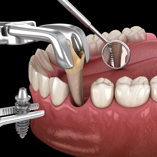 Tooth Extraction In Bangalore | RR Nagar | Chandralayout