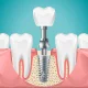 Full Mouth Implant In India | Dental Implant Clinic In India