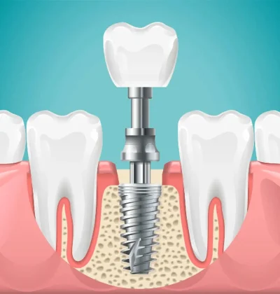 Full Mouth Implant In India | Dental Implant Clinic In India